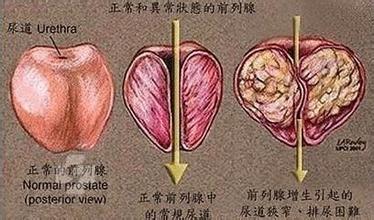 关于前列腺增生的护理哪些不能少