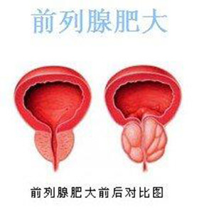 夏季如何预防前列腺肥大