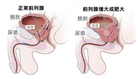 男性前列腺肥大怎么治?